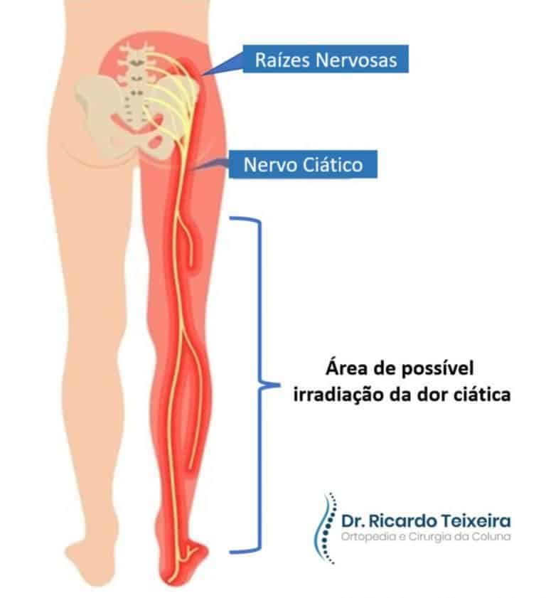 Dor Ciática ou Ciatalgia: Quais são as suas causas?