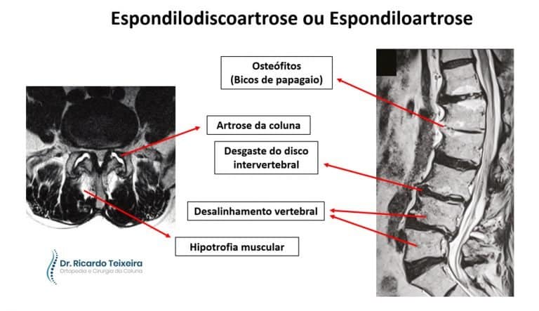 Espondilodiscoartrose ou espondiloartrose - Dr. Ricardo Teixeira